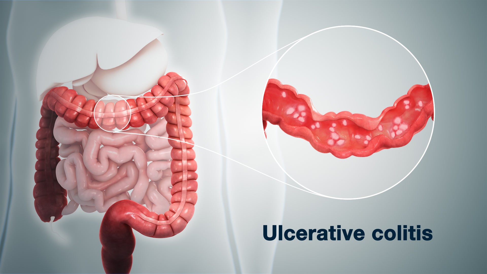 What is Ulcerative Colitis? Common Causes and Ayurvedic its Treatment