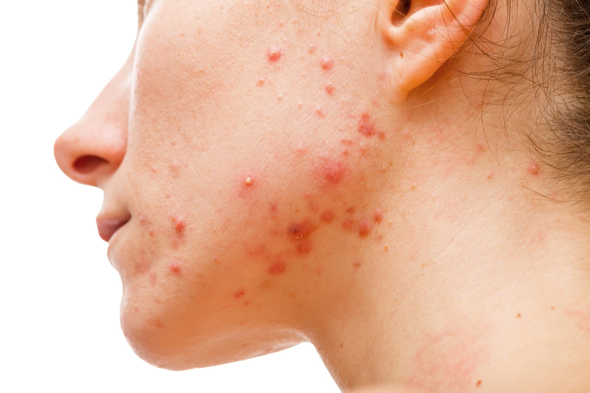 What is the Reason For Acne and its Ayurvedic Treatment