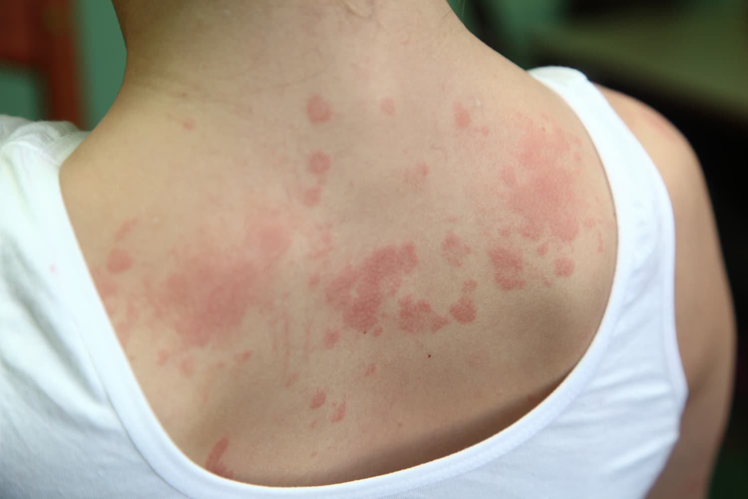 What is Urticaria? What are its symptoms and causes? How to treat it N