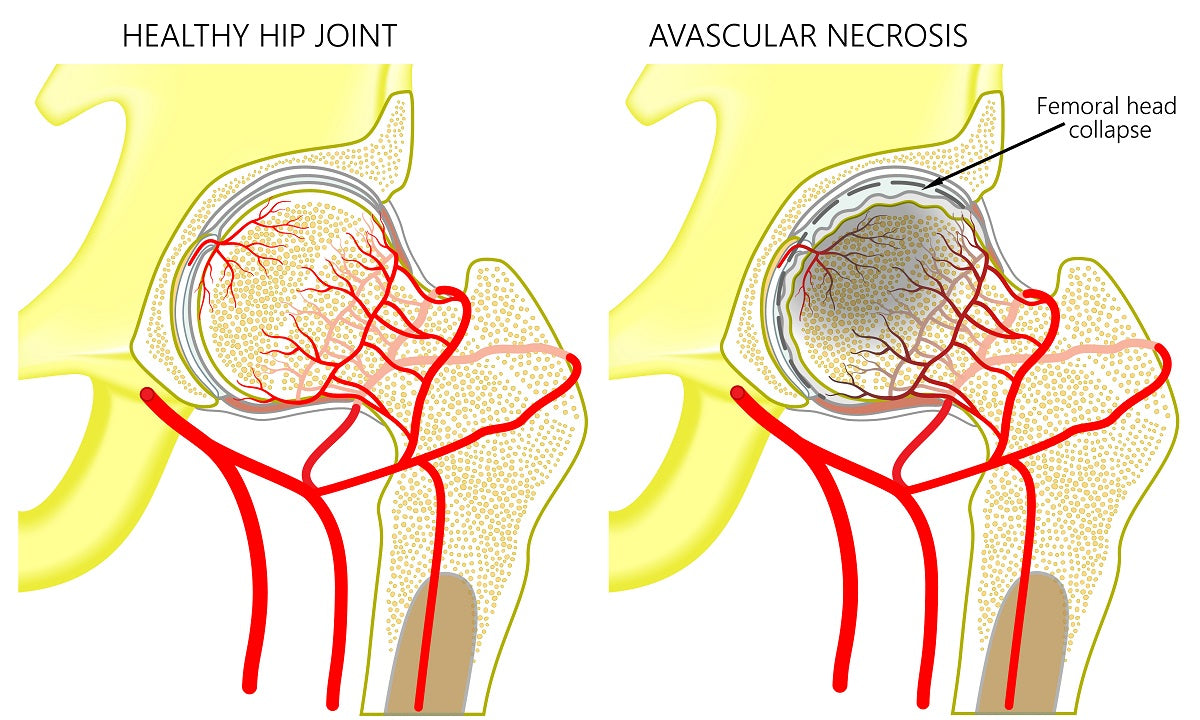 AVASCULAR NECROSIS