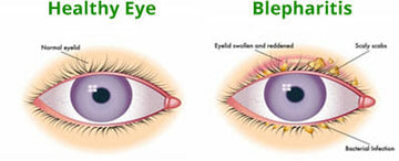 BLEPHARITIS