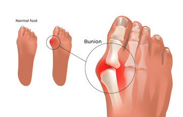 What is Bunion? How it can be treated  in Ayurveda?