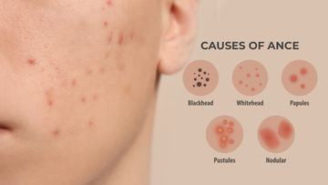 What is Acne ? How to Cure it Naturally