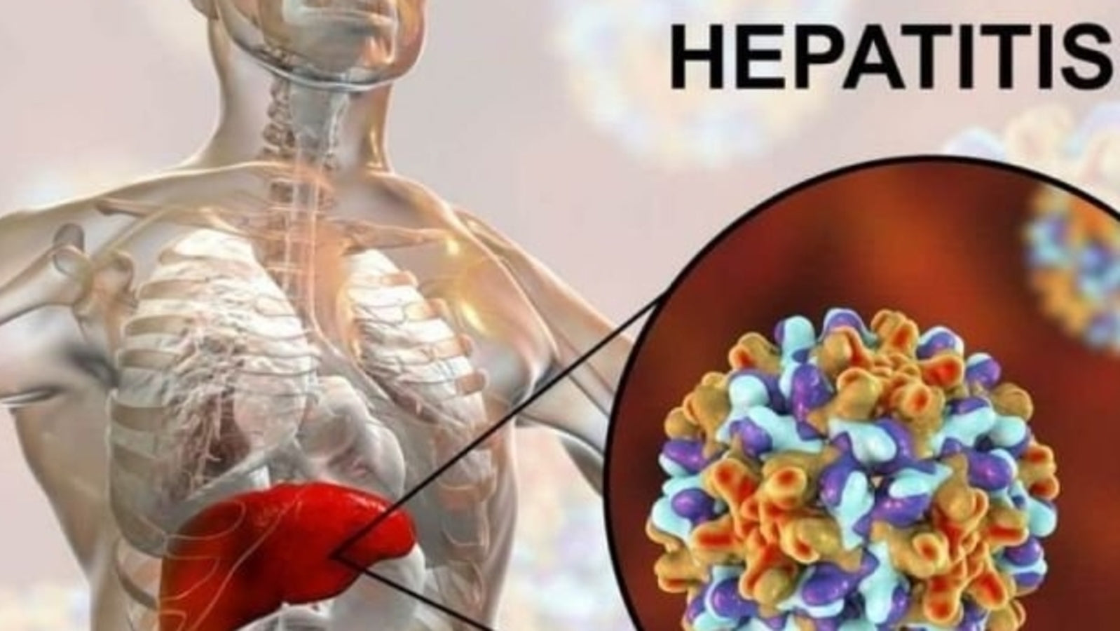 HEPATITIS