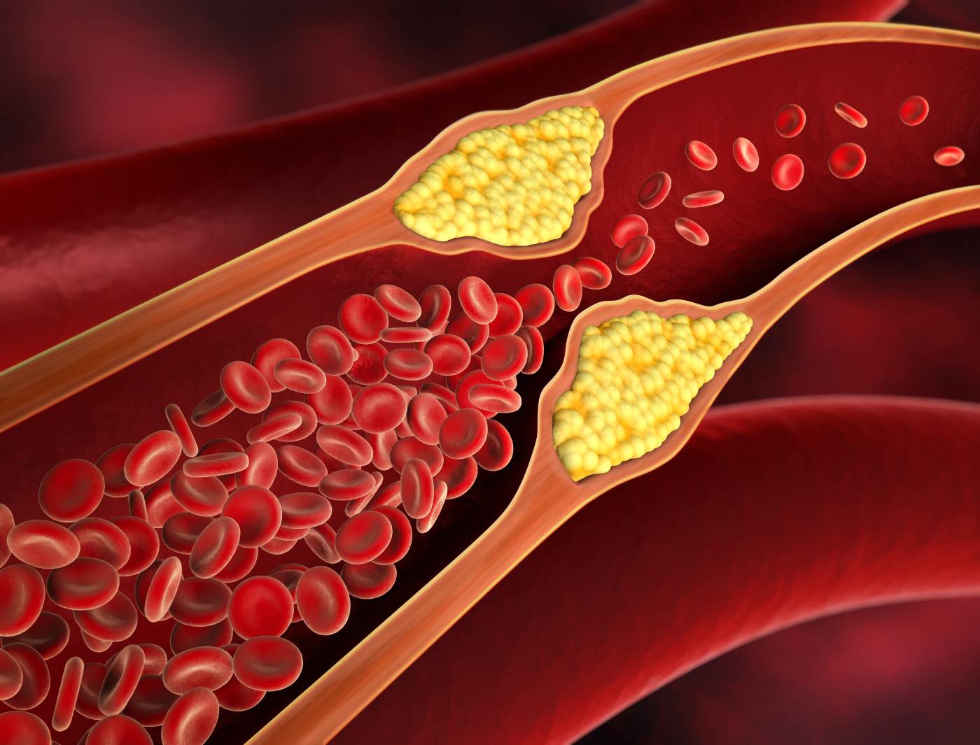 What is Cholesterol? What are the Causes and How to cure it naturally?