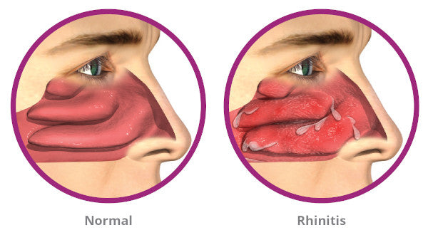  Episodic/Focused SOAP Note for Patient with Allergic Rhinitis