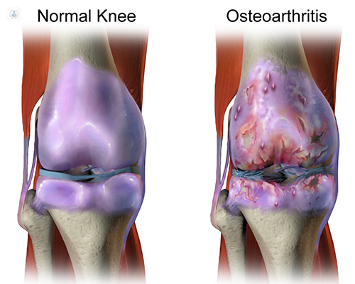 OSTEOARTHRITIS (SANDHIGATA VATA)