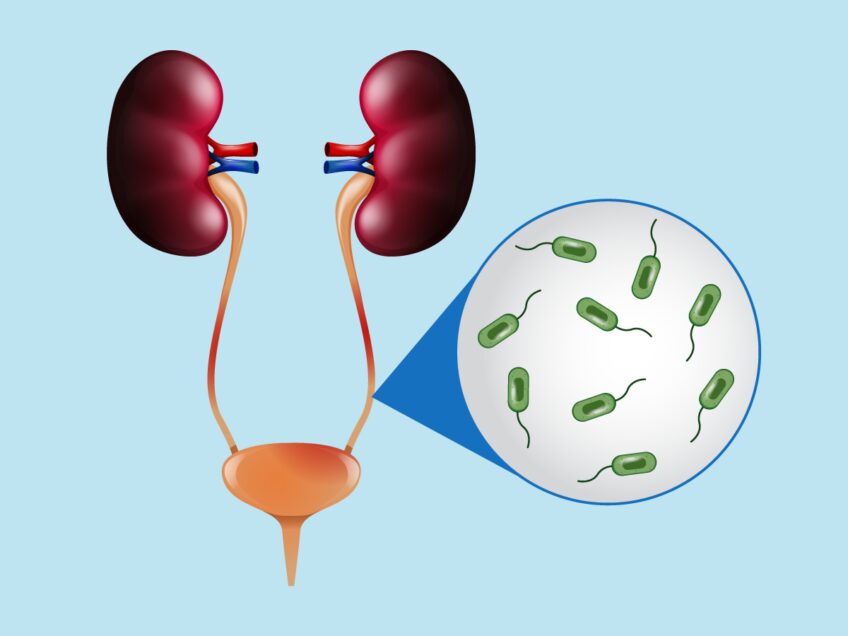 URINARY TRACT INFECTION