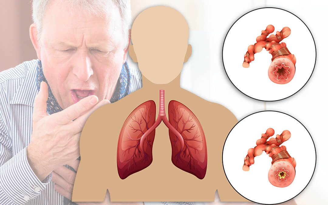 WHAT IS COPD ? HOW TO CURE IT NATURALLY