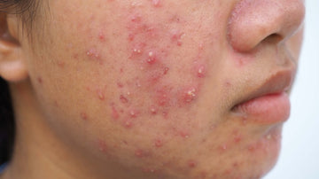 ACNE AND ITS AYURVEDIC TREATMENT