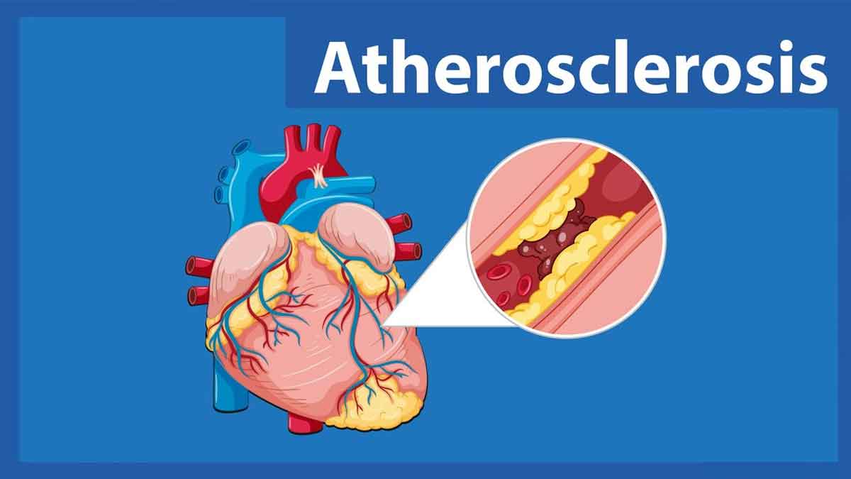 ATHEROSCLEROSIS