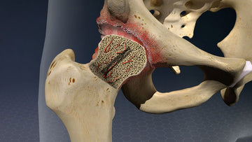 What is Avascular Necrosis (AVN)? How Ayurveda is helps in treating it Naturally?