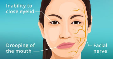 Bell’s Palsy