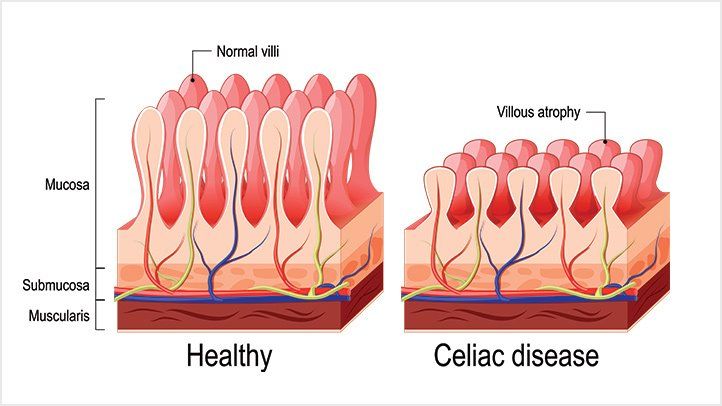 CELIAC DISEASE AND ITS AYURVEDIC TREATMENT