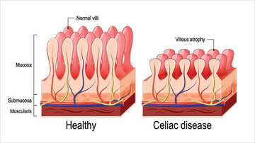 CELIAC DISEASE AND ITS AYURVEDIC TREATMENT