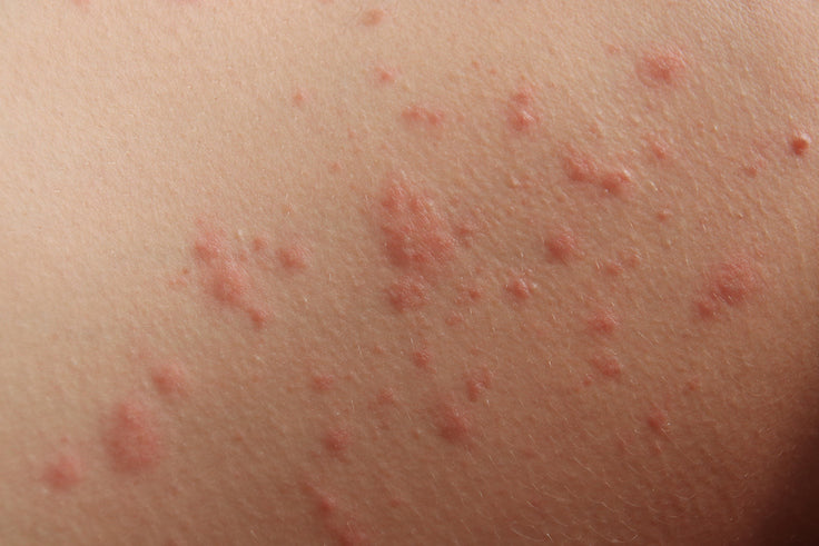 Contac Rash CONTACT DERMATITIS