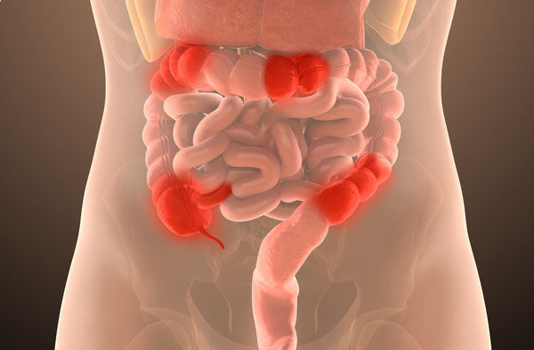 WHAT IS CROHN'S DISEASE ?