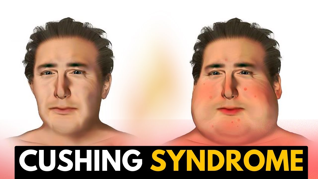 Cushing Syndrome cushing-syndrome