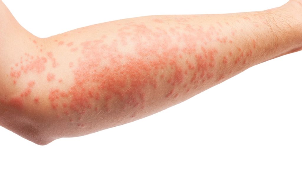 How to treat Eczema Naturally