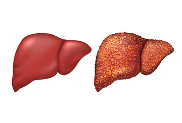 Home Remedies for Liver Cirrhosis