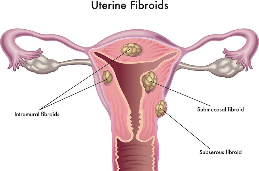 What Are Fibroids? Causes and Its Ayurvedic Treatment