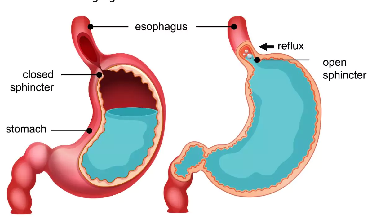 What is GERD? How it can be treated in Ayurveda?