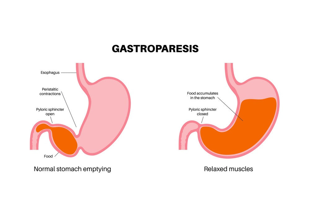 GASTROPARESIS