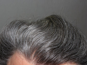 Premature Greying of Hairs