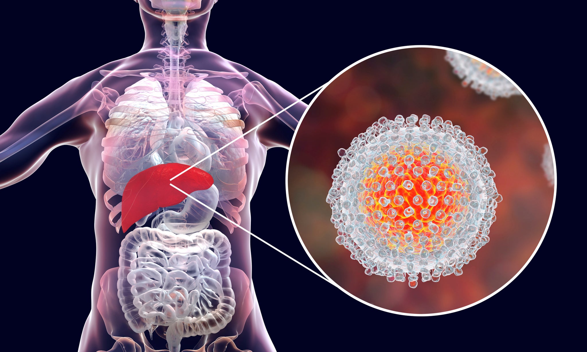 What is Hepatitis C? Causes, Symptoms and Natural Treatment