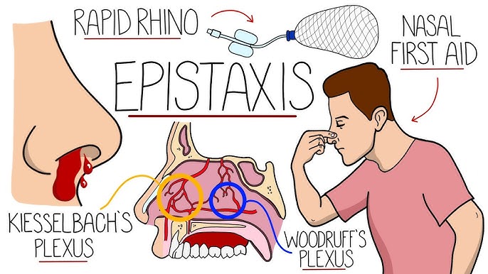 Nose Bleeding Is Called