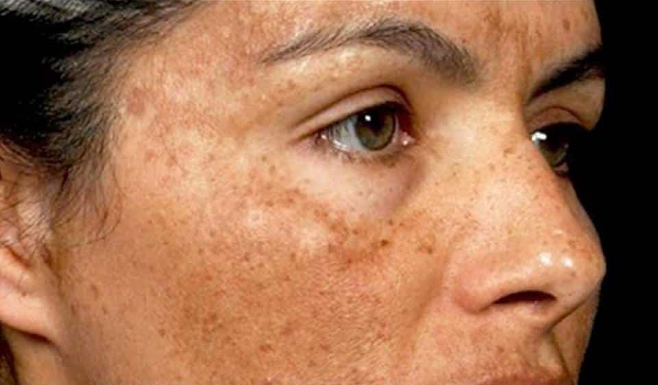 HYPERPIGMENTATION