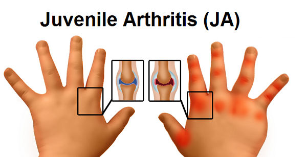 AYURVEDIC MANAGEMENT FOR JUVENILE ARTHRITIS