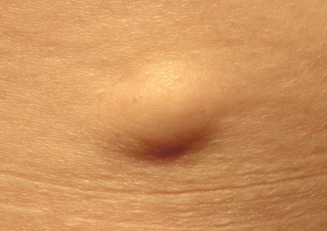 LIPOMA