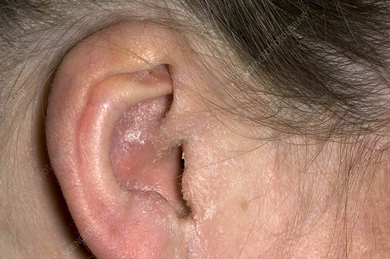 EAR INFECTIONS