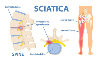 SCIATICA PAIN