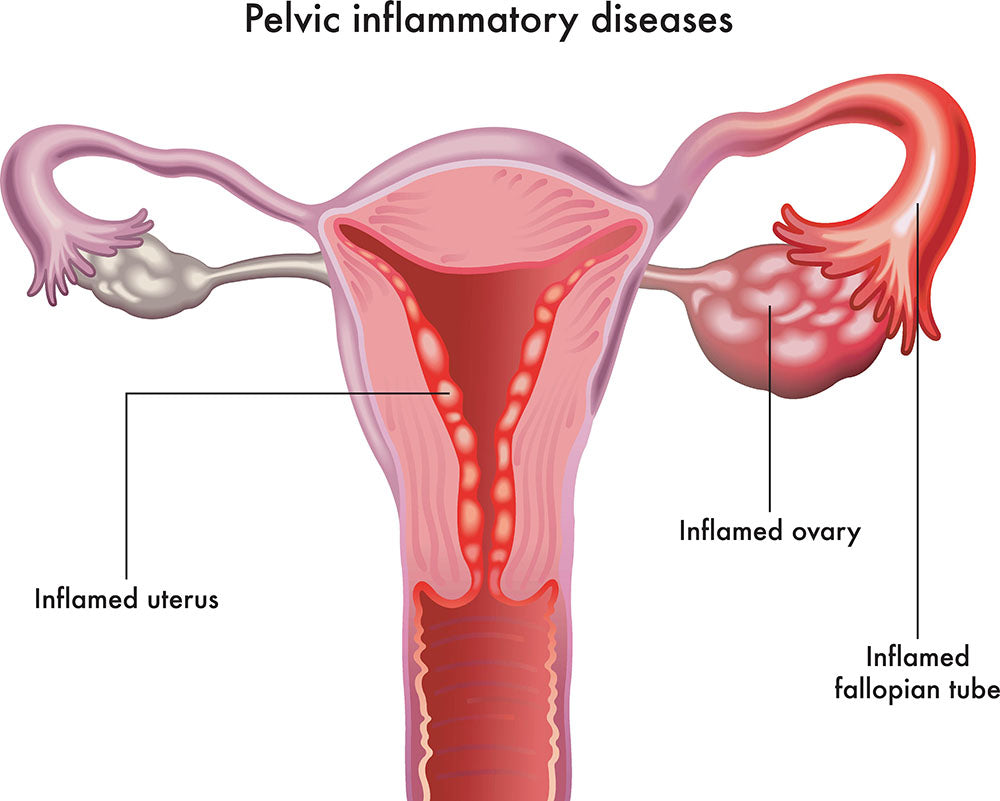 PELVIC INFLAMMATORY DISEASES (PID)