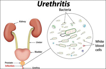 URETHRITIS