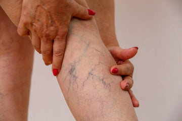 TOP 7 NATURAL REMEDIES THAT PROVIDE RELIEF IN VARICOSE VEINS